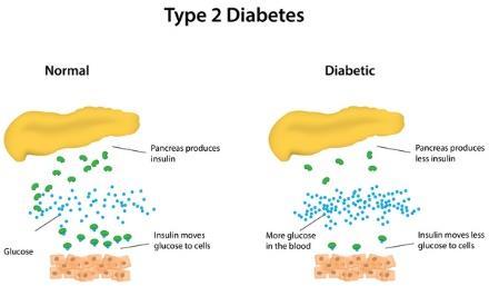 Type 1 diabetes: most commonly occurs in children is a result of the body's immune system attacking and destroying the beta islet cells.