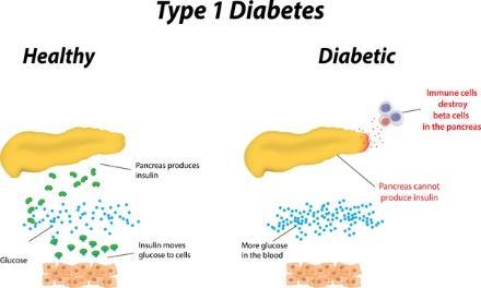 There are many underlying factors that contribute to the high blood glucose levels in these individuals.