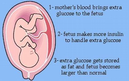 Gestational Diabetes- 3 rd Type of Diabetes Gestational diabetes is diabetes that happens for the first time when a woman is pregnant.