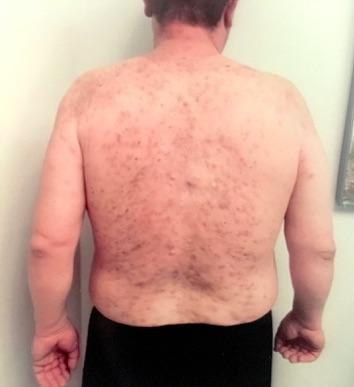 Back. Figure 2 Acne Fulminans after Six Weeks of Treatment on Combination Therapy with Doxycycline and Adalimumab.