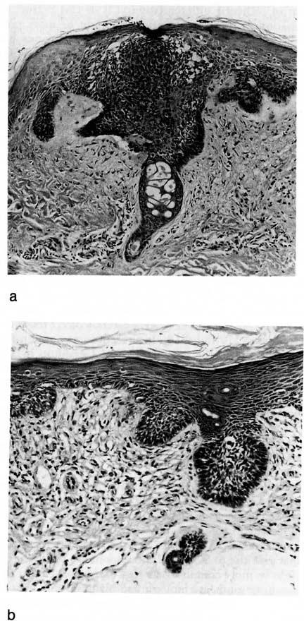 298S Heenan and Bogle THE JOURNAL OF INVESTIGATIVE DERMATOLOGY Figure 6. a) BCC involving acrosyringium. b) BCC involving superficial dermal eccrine duct producing an in situ carcinoma pattern.