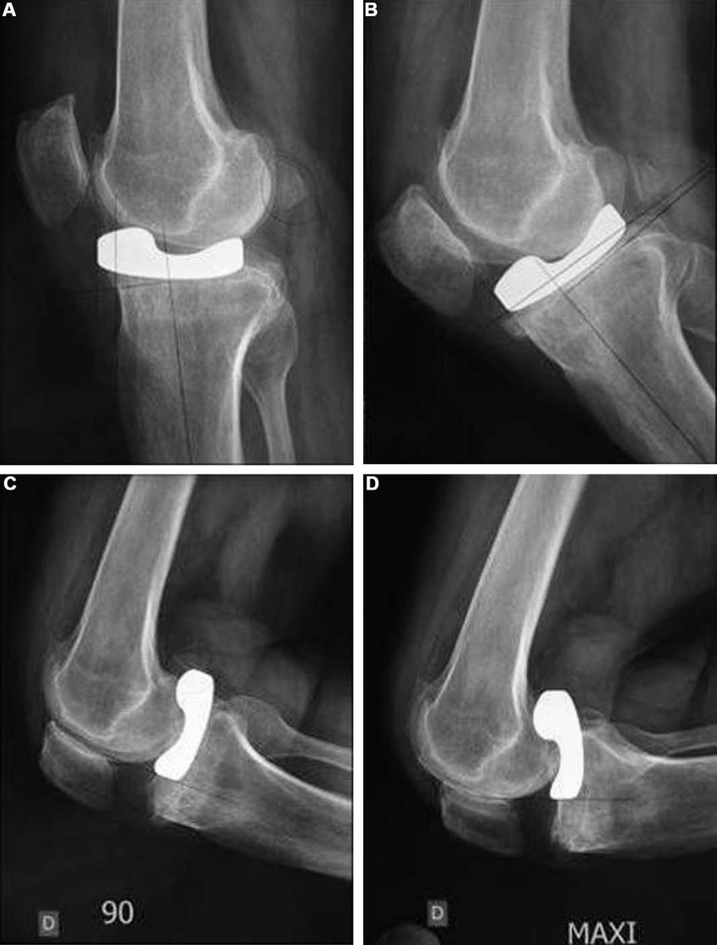 412 C. Catier et al. Figure 2 Radiographic study of the optimal combined sagittal and axial range of motion of an implant (patient 2). ing knee extension.