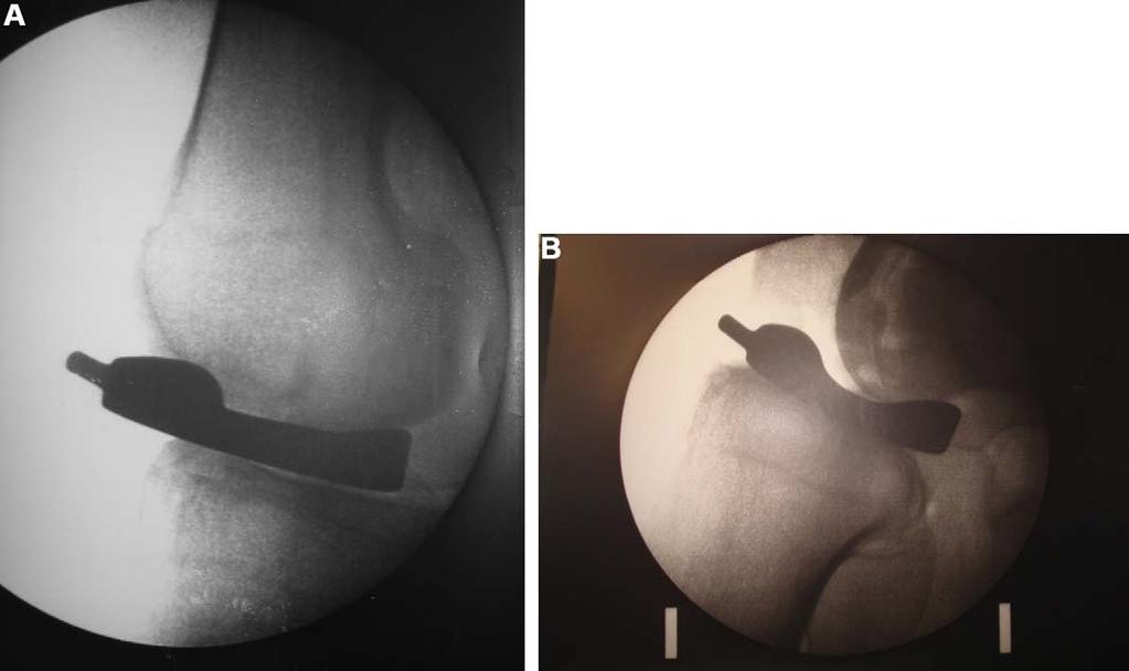 Results and failures of the UnispacerTM knee implant for osteoarthritis of the knee 413 Figure 3 Intraoperative evaluation of the trial implant sagittal trajectory.