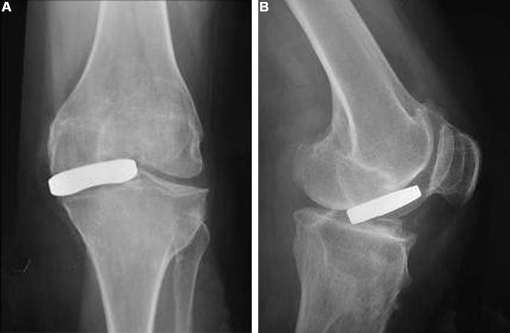 Results and failures of the UnispacerTM knee implant for osteoarthritis of the knee 415 Table 2 Measurement in mm of implant ROM during knee flexion/extension.