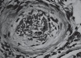 cells (H & E stain x 800). Fig.-3: Photomicrograph showing multilayered crescent formation in the glomerulus.