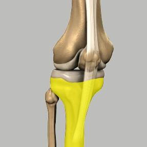 3) Tibia: The tibia (shinbone), the second largest bone in the body, is the weight bearing bone of the leg.