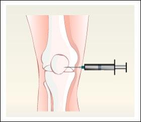 There is no blood test to diagnose Osteoarthritis (wear & tear arthritis).