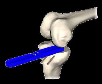 Uniglide Parallel to long axis of tibia Reference medial malleolus Step 6.