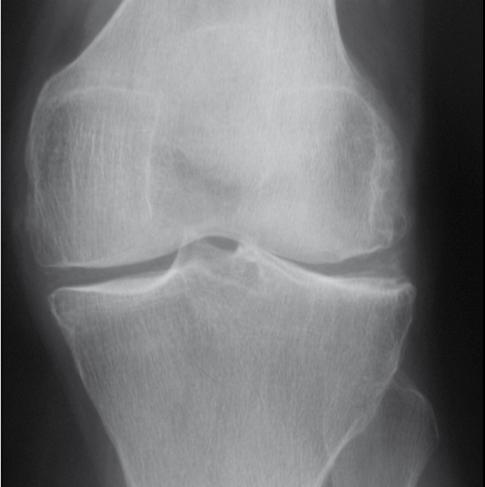 Uniglide Standing A-P Schuss view Pre-operative assessment The Uniglide is indicated for knees with unicompartmental disease and intact ligaments, particularly the ACL.
