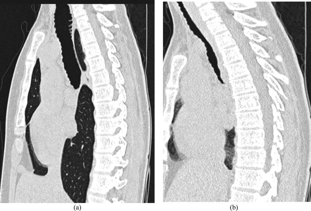 4 M. NYGAARD ET AL. Figure 2. Method 2: paired end-inspiratory (a) and end-expiratory (b) sagittal reconstructed CT images showing maximal collapse of more than 50%. collapse (Method 2).