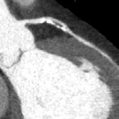 p=0.484) implying that substantial atherosclerosis is present in lesions that are falsely classified as positive for stenosis on CTA despite the