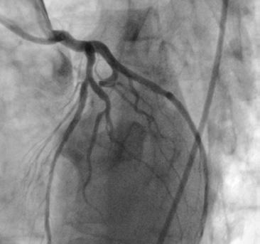 angiography (CTA) and intravascular ultrasound (IVUS) while conventional coronary angiography (CCA) showed no significant CAD.