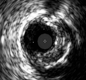 atherosclerosis in the mid LAD (arrow). (B) An enlargement of the mid LAD demonstrating presence of extensive calcifications.