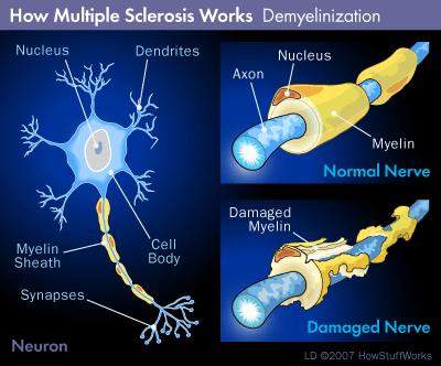 Multiple Sclerosis (MS) is a disease which is inflammatory in nature and is when the insulating coverings of the nerve cells in the brain and spinal cord are damaged and hardened.