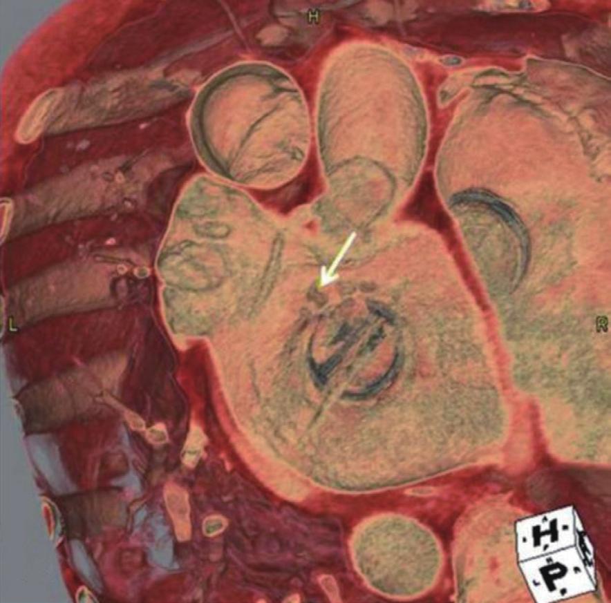 Transesophageal echocardiographic images showing paravalvular leakage.