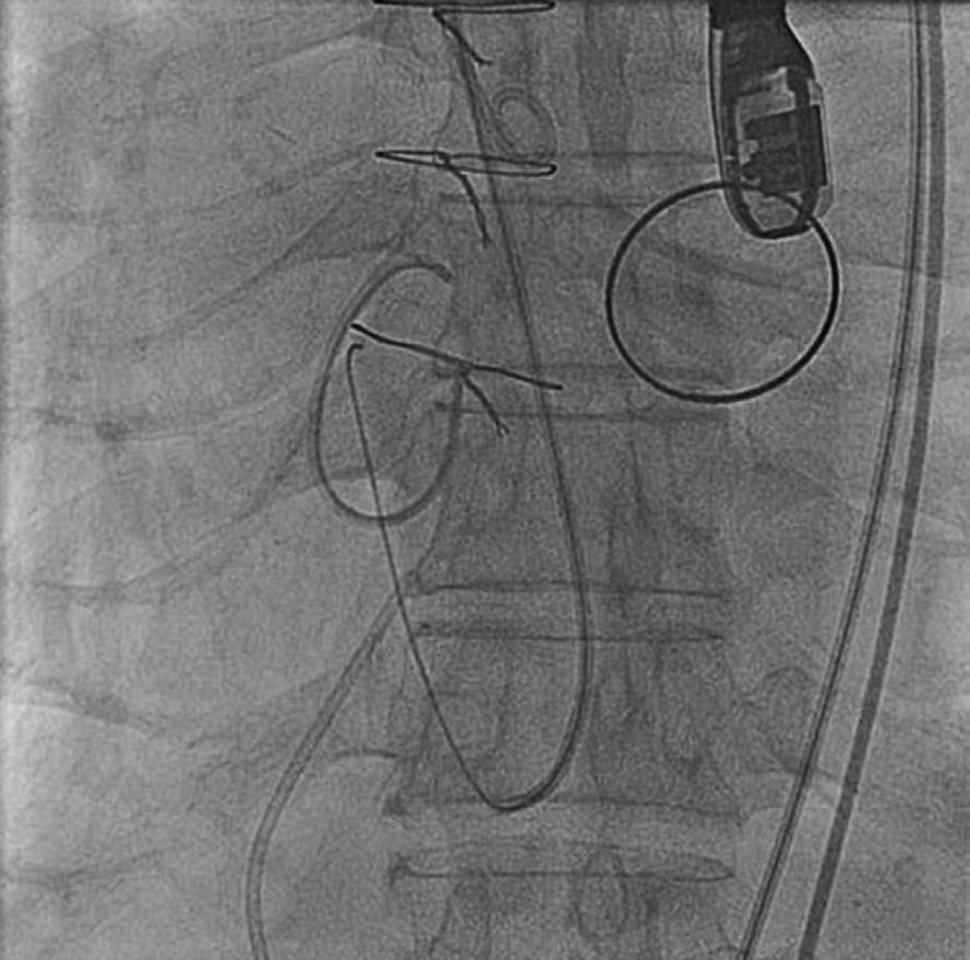 Sang Yong Om, et al. 51 atrium (Fig. 4). Using a Curry intravascular retriever, the guidewire was captured and withdrawn through the right femoral sheath. The guidewire was exchanged for a 0.