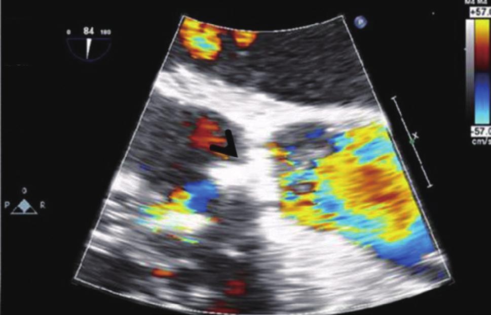 reduced ejection fraction (from 51% to 46%) and persistent resting pulmonary hypertension. Percutaneous closure of the PVL was attempted to decrease left ventricular volume overloading.