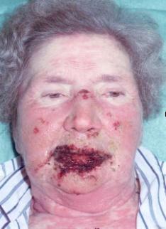 CARBAMAZEPINE Serious allergic rashes HLA B*1502 x 2504 Asians HLA A*3101 x 26 Europeans Stevens-Johnson