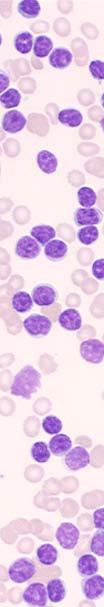 Chronic Lymphocytic Leukaemia (CLL) Most common leukaemia in adults Diagnosis straightforward CD19+/CD5+/CD23+ lymphocytosis Molecular pathogenesis unresolved