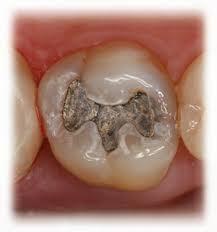 Tooth Preparation When replacing a defective restoration (recurrent caries lesion), the outline form will be