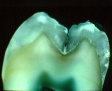 ???????Why union failure of tooth lobes organic debris