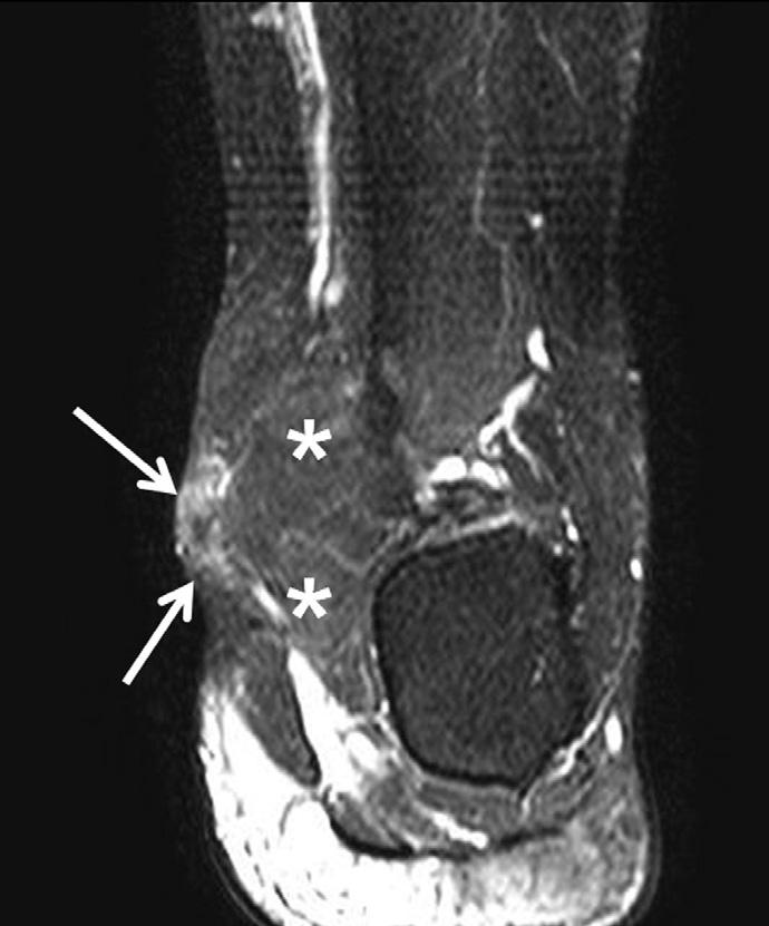 The mass was welldefined, multi-lobulated, and oval-shaped in character, and was located in the medial subcutaneous tissue of the ankle. The mass measured 4.5 x 3.2 x 2.