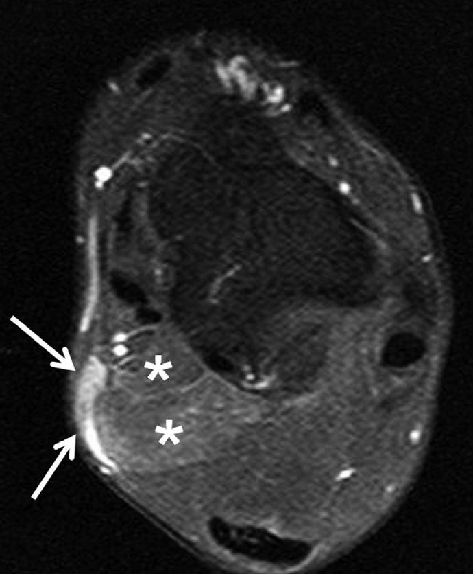 Axial T1-weighted image shows soft tissue mass (arrows) in subcutaneous region at level of posteromedial ankle joint. B, C.