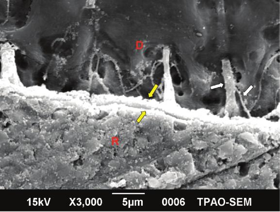 Thin and cylindirically-shaped resin tags and their lateral branches are clearly identified (white arrows). Yellow arrows show the hybrid layer. R: resin, D: dentin. Figure 6.