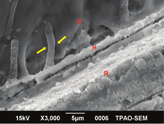 DISCUSSION It has been suggested that the essential mechanism of adhesion between dentin bonding systems and the dentin substrate is the formation of a hybrid layer composed of resin that has been