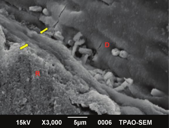 tion of dentinal tubules with sclerotic casts and the presence of an acid resistant hypermineralized layer.