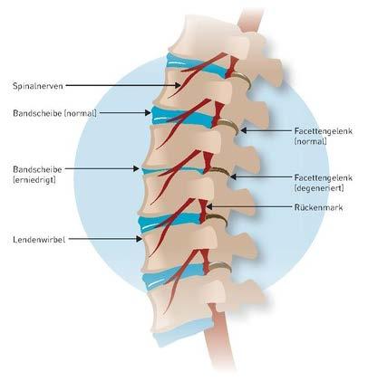 We have pioneered the industry s latest proven alternatives to surgery and steroids. Our in-office, same-day procedures will alleviate your back pain regardless of the cause.