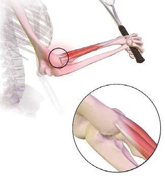 elbow. We have pioneered the industry s latest proven alternatives to surgery and steroids. Our in-office, same-day procedures will alleviate your elbow pain regardless of the cause.