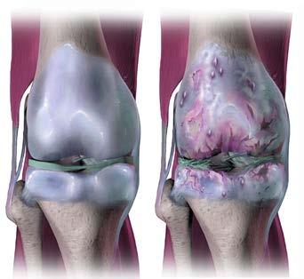 Regenerative Medicine for Knee Degeneration Degeneration of the joints can occur in any of the joints in the body, especially those that experience lots of wear and tear.