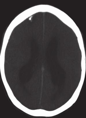 2 Case Reports in Infectious Diseases Figure 1: Head CT showing diffuse cerebral edema with ventriculomegaly.