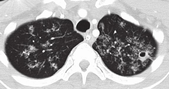 Case Reports in Infectious Diseases 3 Figure 3: Chest CT scan showing diffuse airspace disease with associated reticular nodular opacities and apparent tree in bud configuration with small cavitary