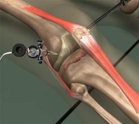 Unit 3: Treatment Options With the images from the arthroscope as a guide the surgeon can look for any pathology or anomaly and repair it through the other