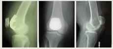 Unit 2: Patellofemoral Instability X-rays: A form of electromagnetic