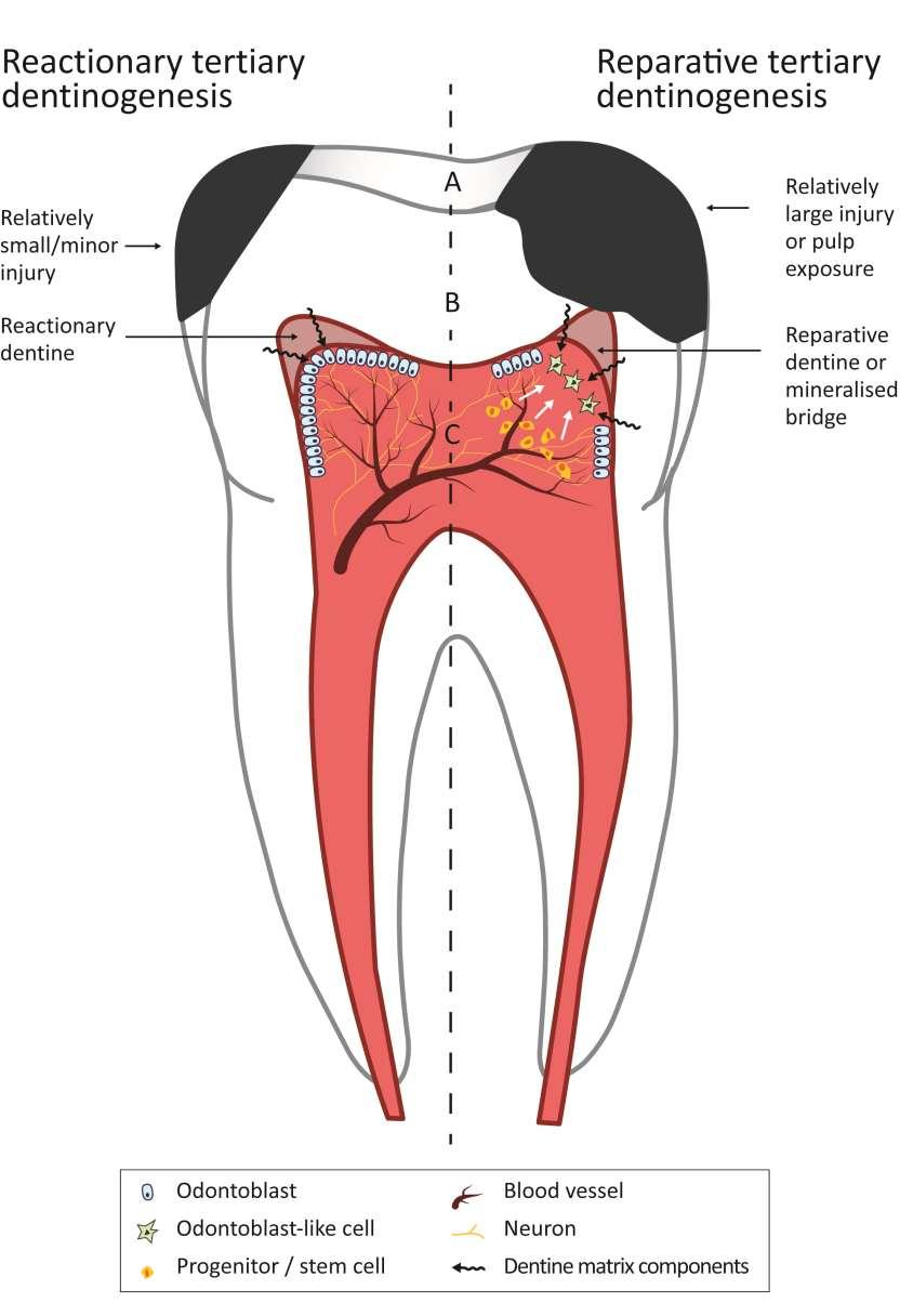 Caries: Pulp irritation, antigen recognition by odontoblasts, initially