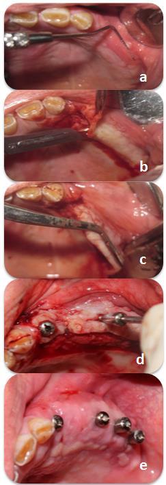 J Dent (Tehran) Mohseni Salehi et al resorbed maxillary ridges or after flap advancement during bone augmentation surgery.