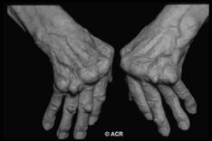 the small joints of the hands and feet, particularly the proximal