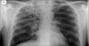 DIAGNOSIS OF TUBERCULOSIS Even in developed countries, the gold