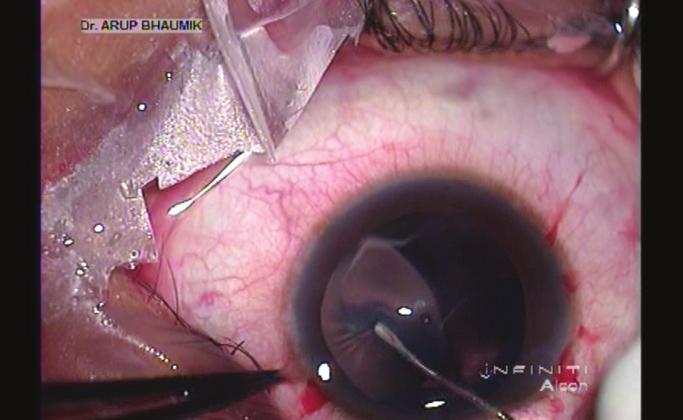 CATARACT FUNDAMENTALS (Continued from page 74) INCISION The modern cataract surgeon is likely accustomed to using a clear corneal temporal incision.