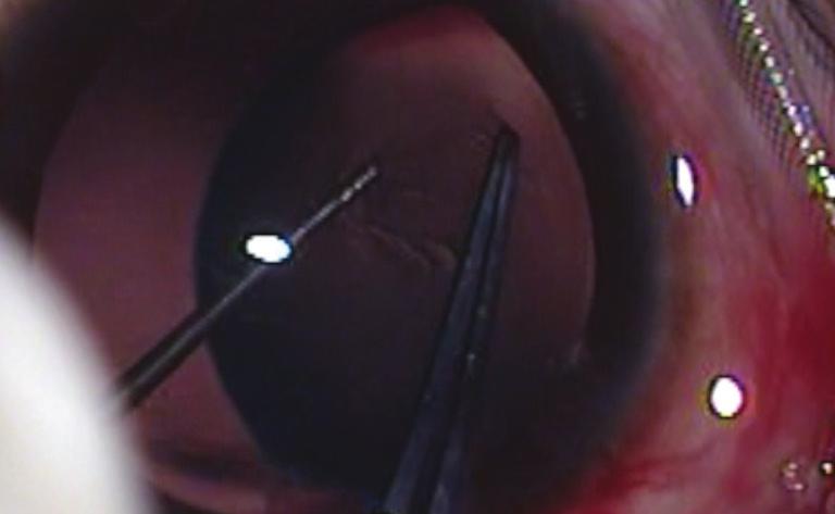The paracentesis wound for a second instrument should be more corneal to prevent injury to the rhexis margin, which tends to be slightly anteriorly tented after fixation of iris hooks.