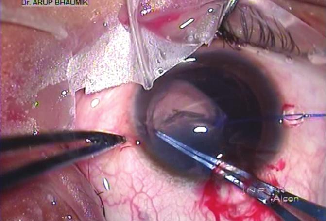 In this situation, the capsular bag must be supported with hooks, even if the area of subluxation is small.