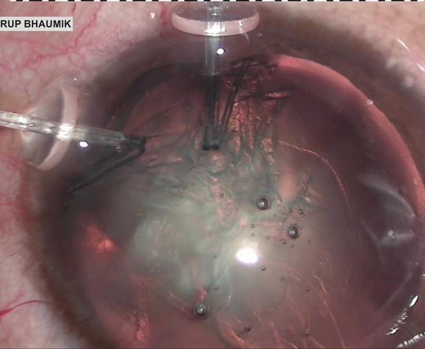 In patients with deep anterior chambers, a capsular hook may be placed through a prelimbal stab incision to reduce the chance of the hook slipping (Figure 6).