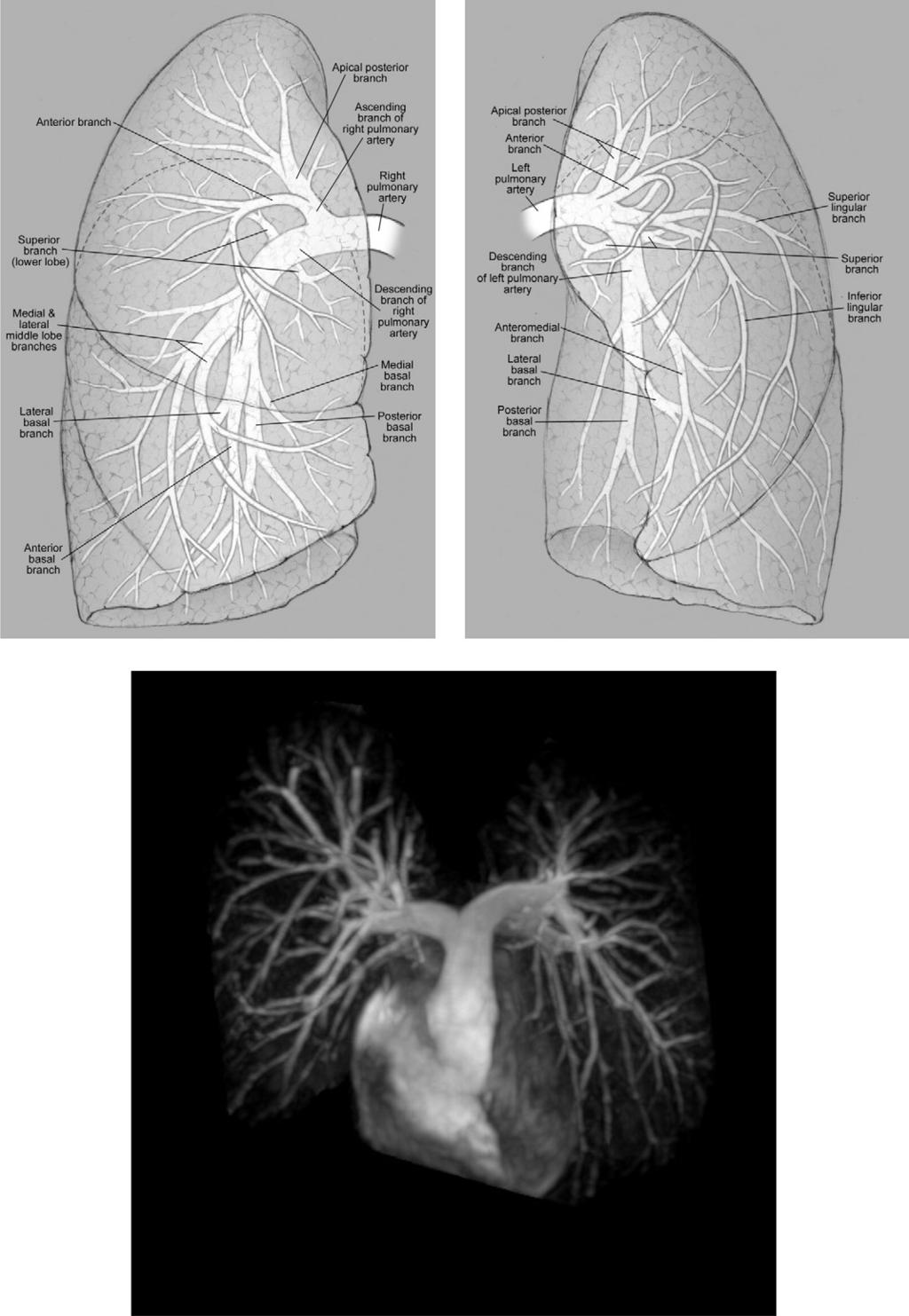 254 S.R. Meyer and C.G.A. McGregor Figure 2 A sound knowledge of segmental pulmonary artery anatomy is essential for both a complete and a safe operation.