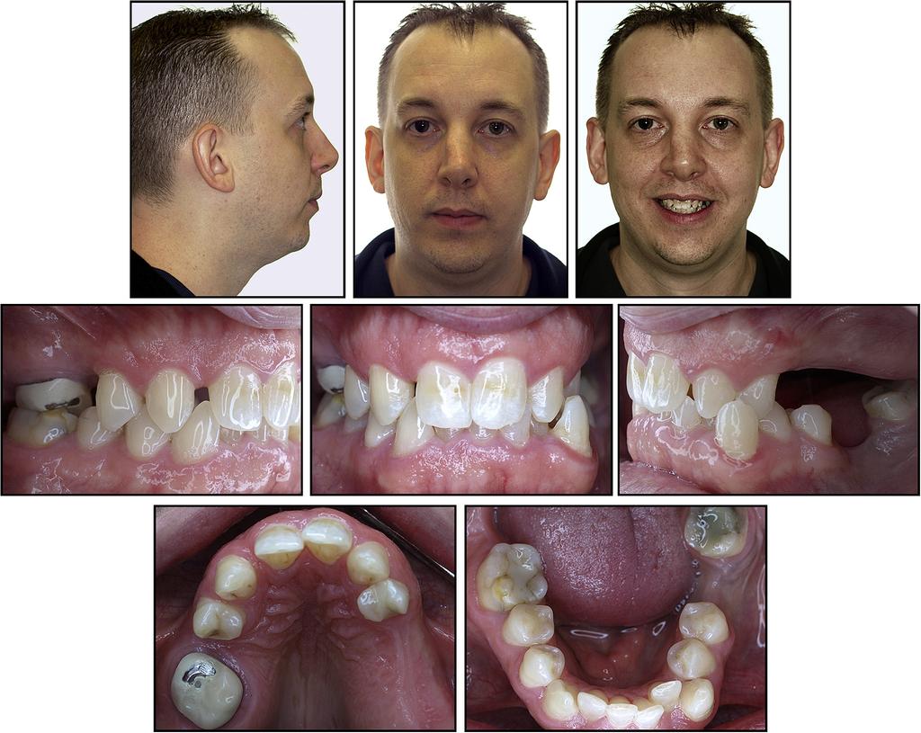 868 Uribe, Janakiraman, and Nanda Fig 1. Pretreatment photographs. rest, and an obtuse nasolabial angle (Fig 1). He had a flat smile arc with asymmetric animation of the smile.