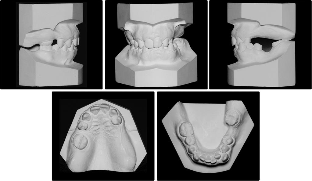 Uribe, Janakiraman, and Nanda 869 Fig 2. Pretreatment dental casts. Fig 3. Pretreatment panoramic radiograph. mandibular plane angle.