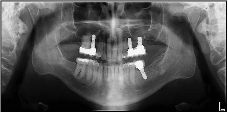 Uribe, Janakiraman, and Nanda 873 Fig 8. Posttreatment dental casts. Fig 9. Posttreatment panoramic radiograph. indicating good delivery of the mechanical plan.