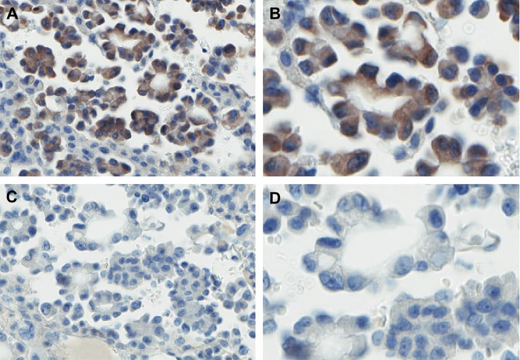 EML4-ALK detection in NSCLC 51 Figure 4 Immunohistochemistry staining confirms expression of ALK1 protein.